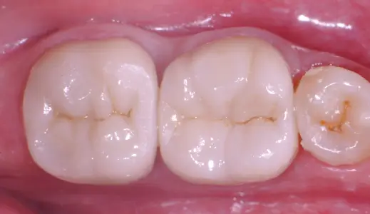 Posterior Crown After