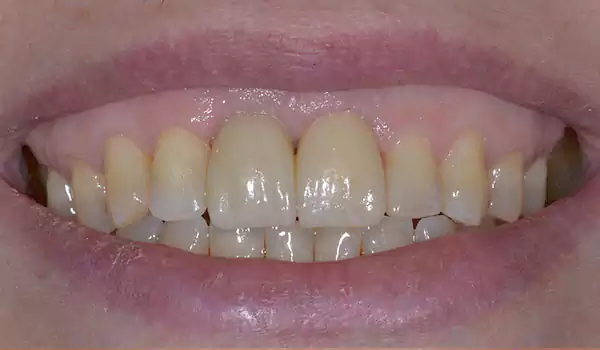 missing anterior teeth with impants after