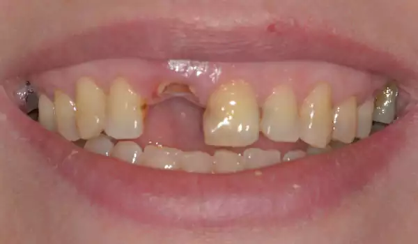 missing anterior teeth with impants before